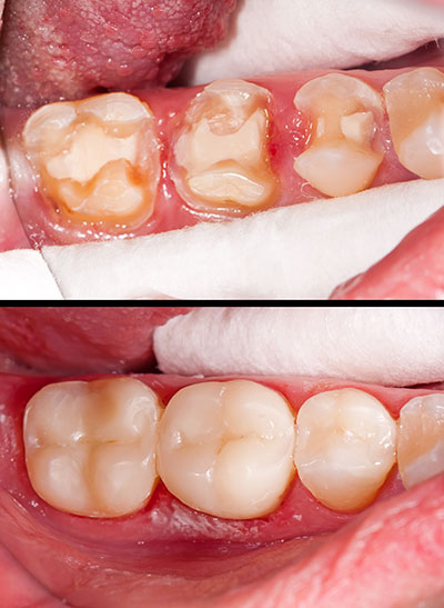 Pulaski Dental | Periodontal Treatment, Ceramic Crowns and Veneers