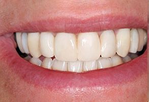 Pulaski Dental | Night Guards, Teeth Whitening and Dentures